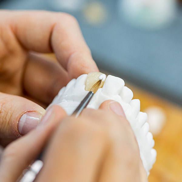 An anterior tooth crown made of VITA AMBRIA Press Ceramic is stained