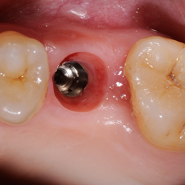 Nach dem Ausschrauben des Gingivaformers zeigte sich das ausgeformte Emergenzprofil.