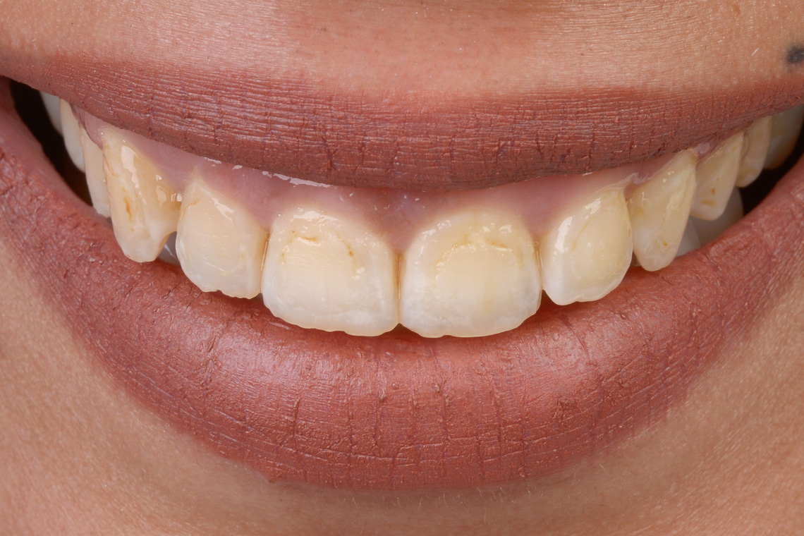 La situación de partida con sonrisa gingival e incisivos cortos en la zona estética.