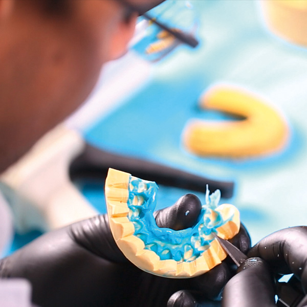 La llave de silicona confeccionada se moldeó mediante un bisturí a lo largo del margen gingival.