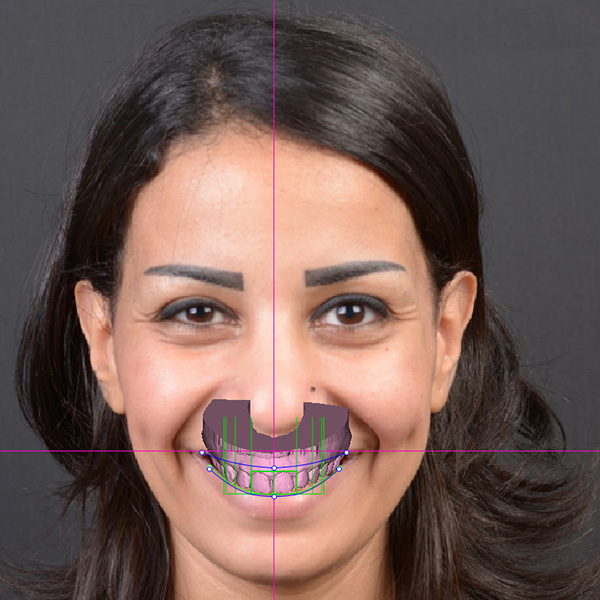 …, per realizzare un modello wax-up virtuale.