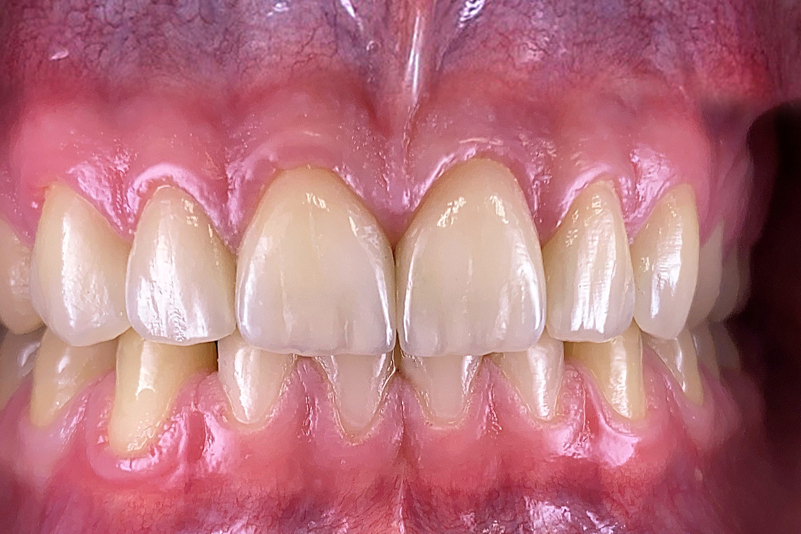 Das abschließende Ergebnis nach der volladhäsiven Zementierung der hochästhetischen Veneers.