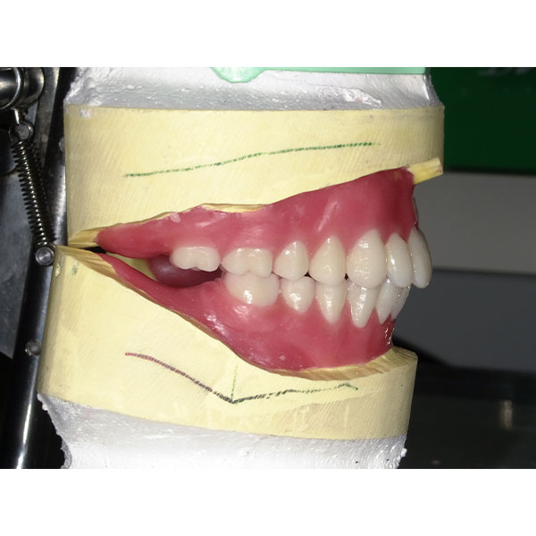 Trotz der Angle-Klasse II war es gelungen, eine Neutralbisslage zu realisieren.