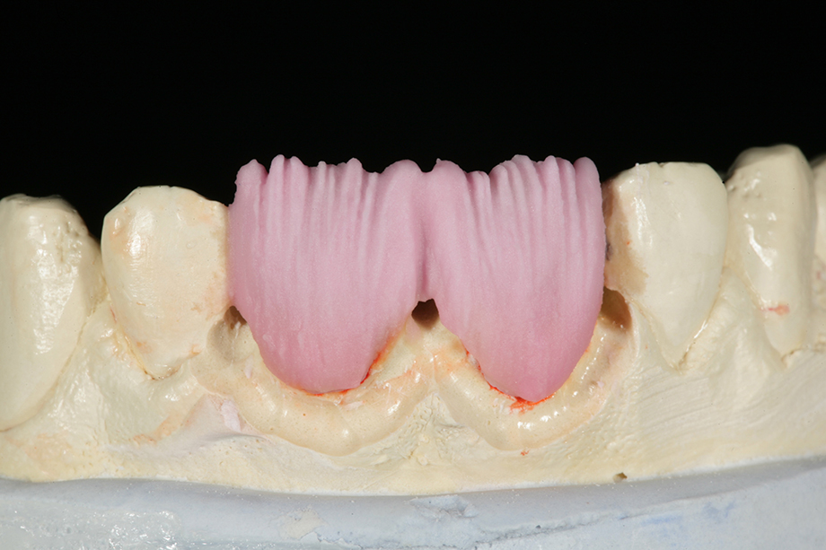 Patientenfall Amos Harting, USA. M 9 BASE DENTIN Auftrag.