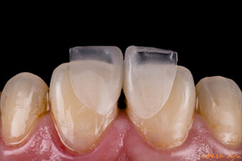 CEREC Digest: Patientenfall von Hsuan Chen